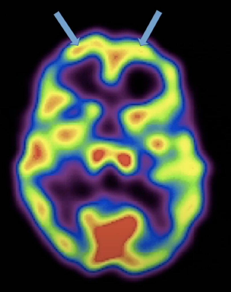 Frontal Lobe meditation