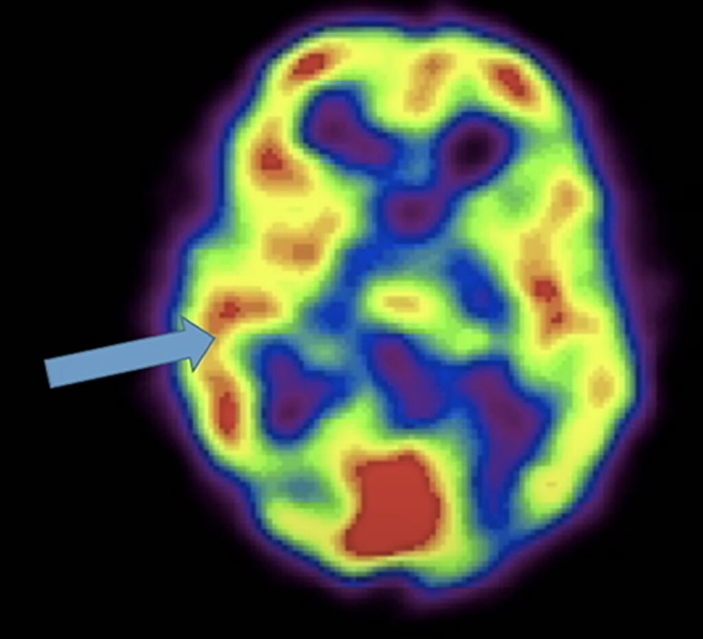 role of limbic system