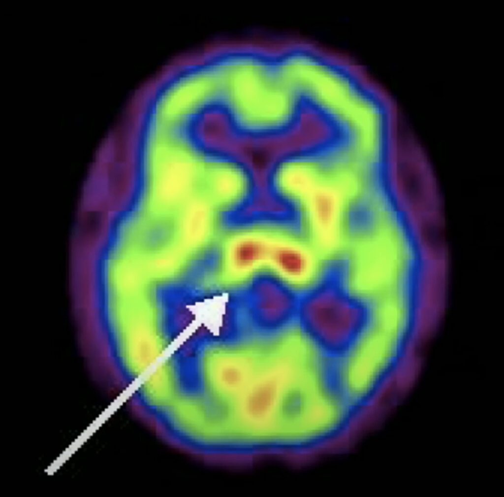 Thalamus Brain Scan at Rest