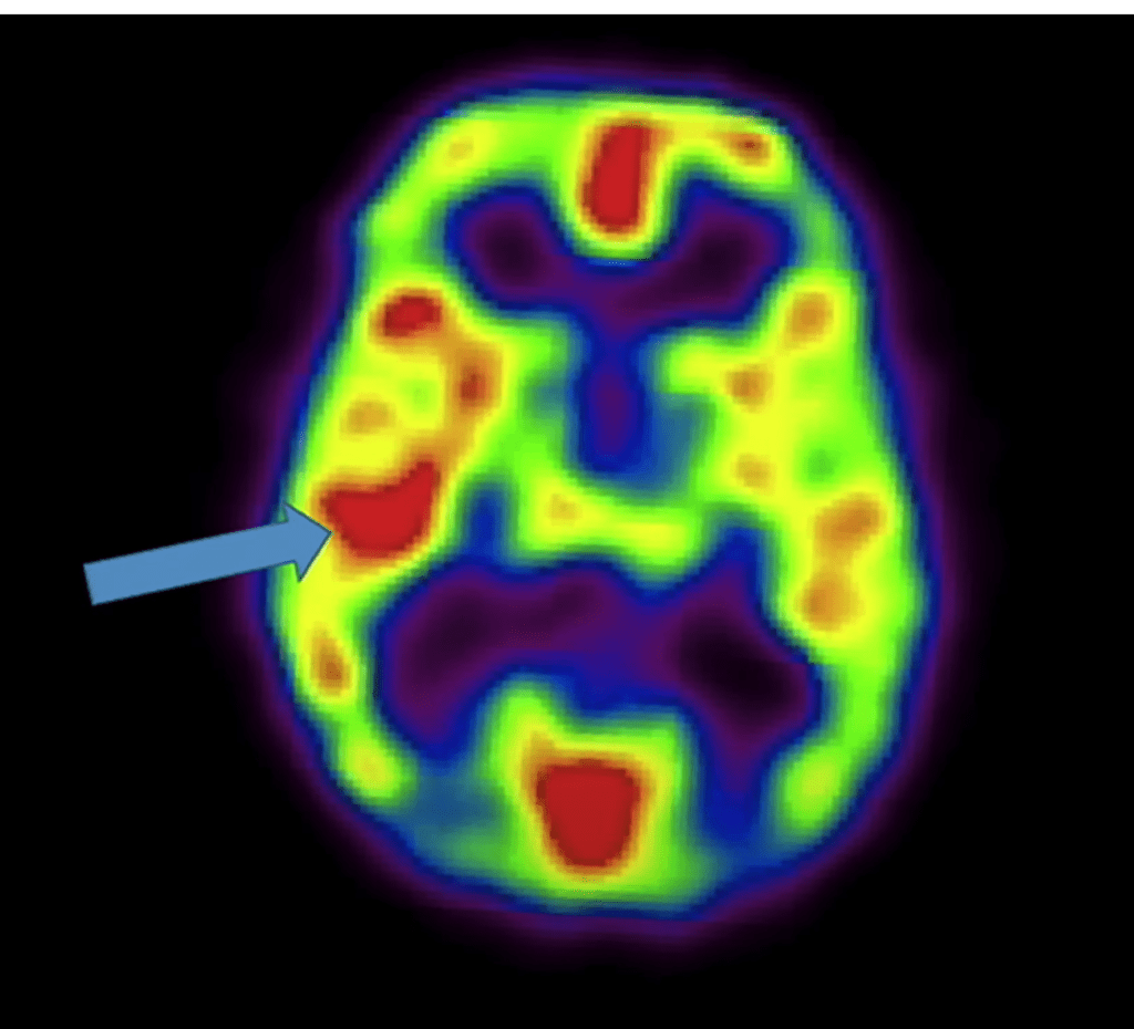 Limbic Area During Enlightenment